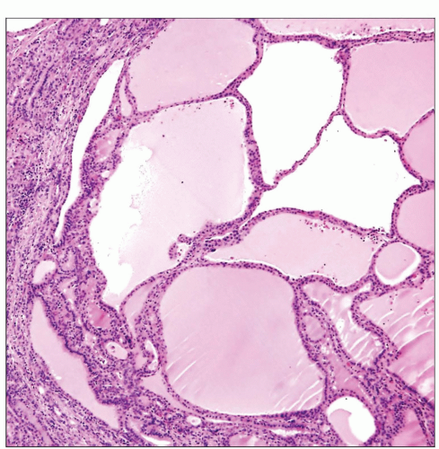 Ectopic Thyroid Tumor Basicmedical Key 