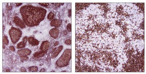 Nodular Lymphocyte Predominant Hodgkin Lymphoma | Basicmedical Key