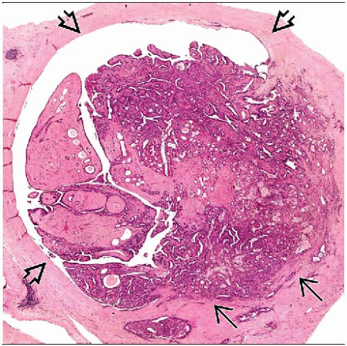 Papilloma, Large Duct and Small Duct | Basicmedical Key