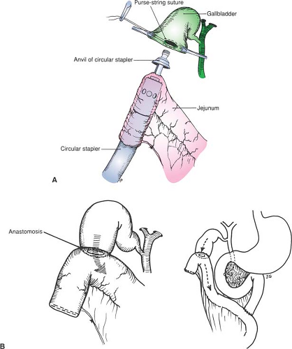 Choledochoduodenostomy And Other Biliary Bypass Procedures ...