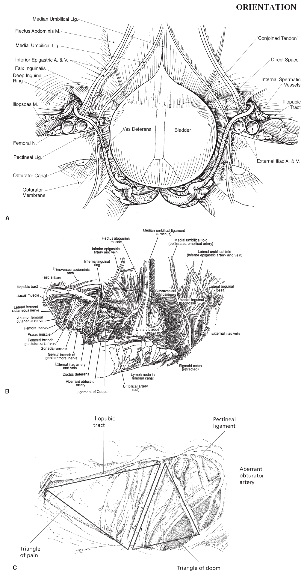 Laparoscopic Inguinal Indirect Hernia Repair