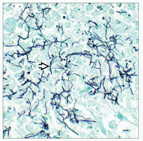 Nocardiosis | Basicmedical Key