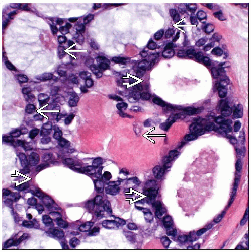 Adenoid Cystic Carcinoma Basicmedical Key 