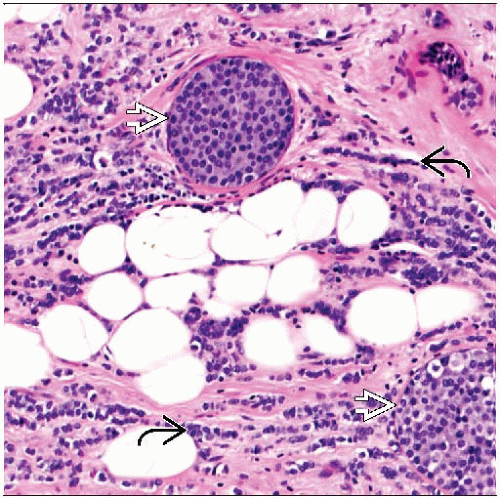 invasive-lobular-carcinoma-basicmedical-key