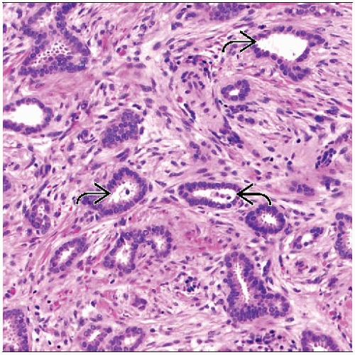 tubular carcinoma breast