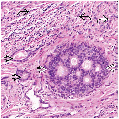 Tubulolobular Carcinoma | Basicmedical Key