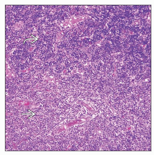 Lymphomas Associated With Fgfr1 Abnormalities Basicmedical Key 