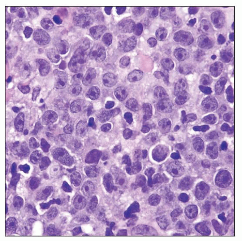 Primary Cutaneous Diffuse Large B Cell Lymphoma Leg Type