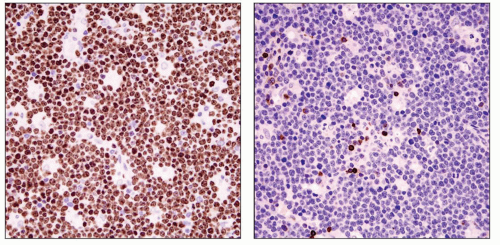 Primary Effusion Lymphoma (PEL) And Solid Variant Of PEL | Basicmedical Key