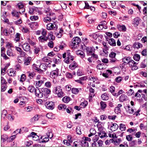 Lymphoma Basicmedical Key 