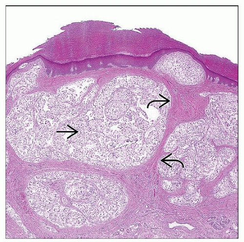 Dermal Nerve Sheath Myxoma | Basicmedical Key