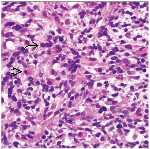 Embryonal Rhabdomyosarcoma | Basicmedical Key