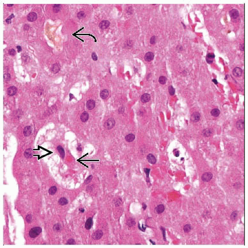 Hemophagocytic Syndromes | Basicmedical Key