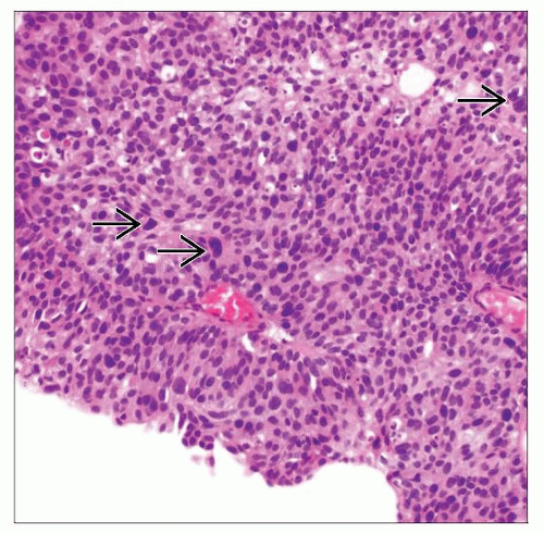 high-grade-papillary-urothelial-carcinoma-basicmedical-key