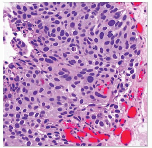 table-1-from-grading-of-urothelial-carcinoma-and-the-new-world-health