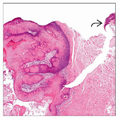 Epidermal Inclusion Cyst Histology