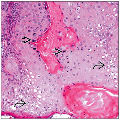 Epidermoid Cyst Histology