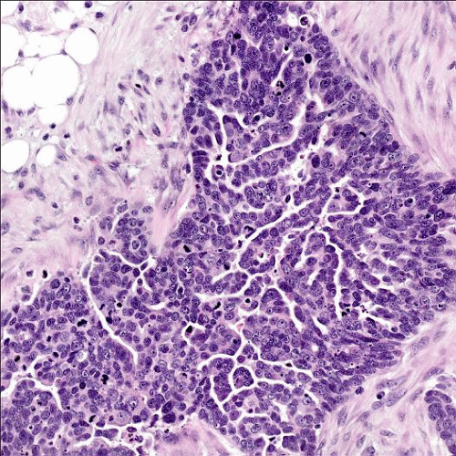 Metastatic High Grade Serous Carcinoma Icd 10