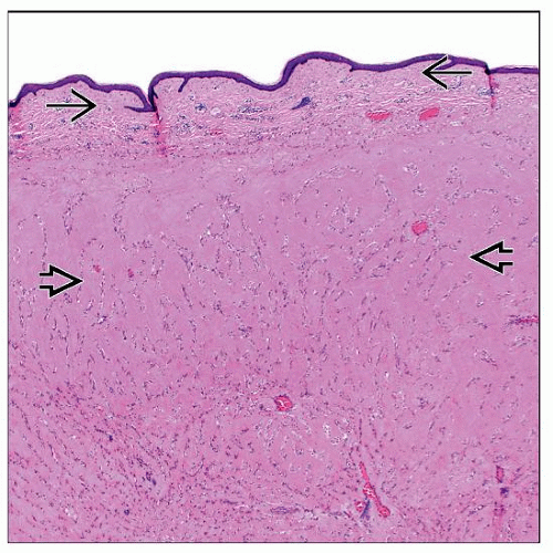 Juvenile Hyaline Fibromatosis | Basicmedical Key