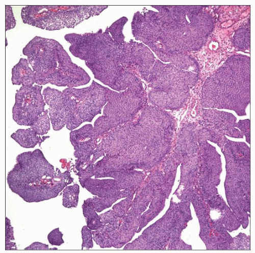 What Does High Grade Papillary Urothelial Carcinoma Mean