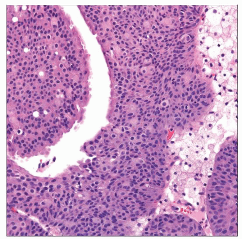 american-urological-association-papillary-urothelial-carcinoma-high