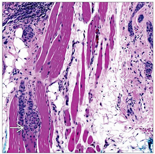 Microcystic Adnexal Carcinoma | Basicmedical Key