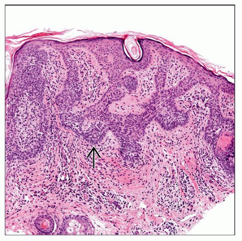 Nevus Sebaceus and Follicular Hamartomas | Basicmedical Key