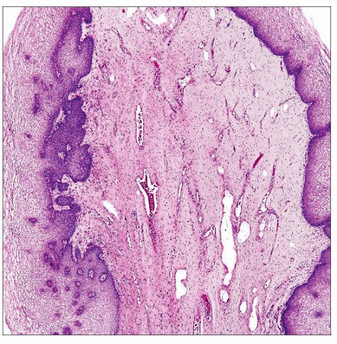 Polyps | Basicmedical Key