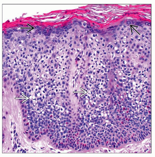 Squamous Cell Carcinoma In Situ Histology Researchers Identify Cheap Squamous Cell Carcinoma In Situ Histology Researchers Identify Cheap