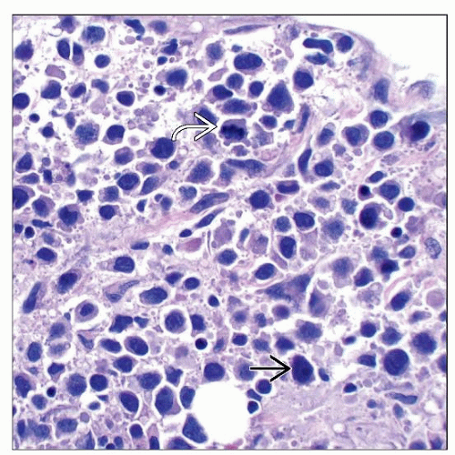 Extranodal NK-/T-cell Lymphoma, Nasal Type | Basicmedical Key