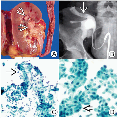 urothelial-carcinoma-basicmedical-key