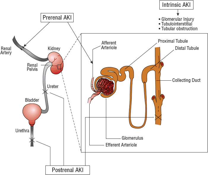 acute-kidney-injury-basicmedical-key