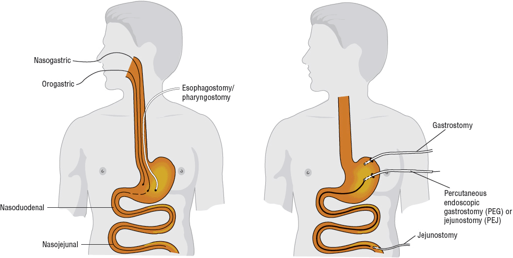 Enteral Nutrition | Basicmedical Key