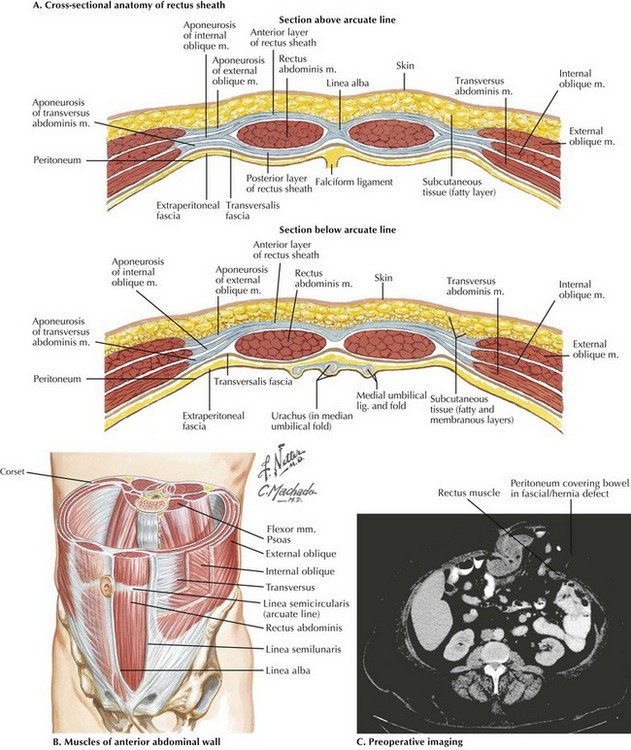 Abdominal Wall Anatomy and Ostomy Sites Basicmedical Key