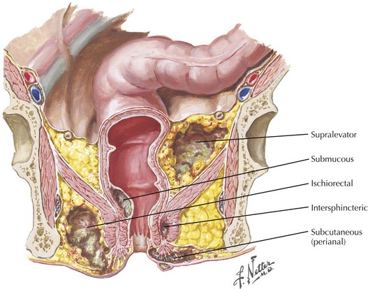 perirectal abscess