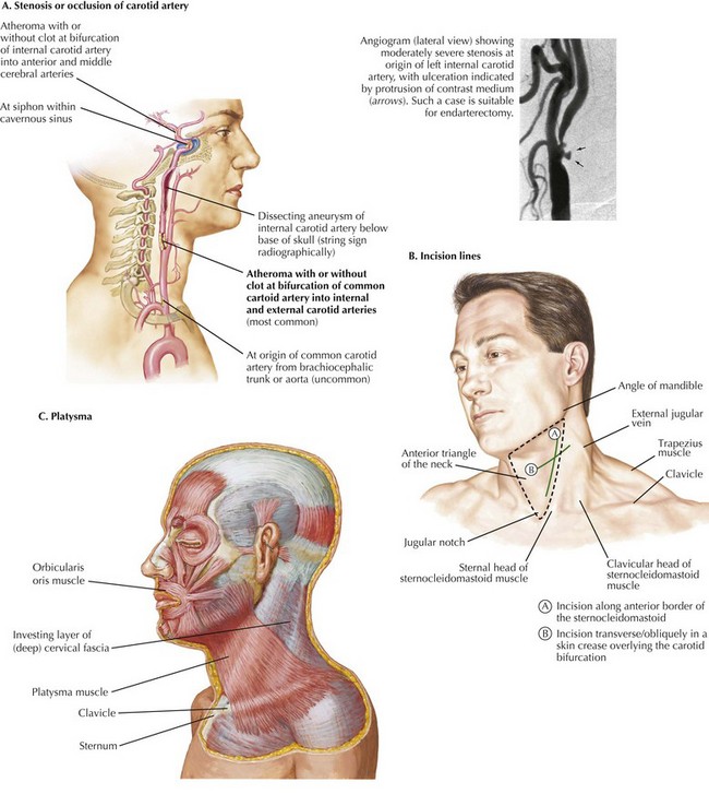 Подкожная мышца шеи platysma