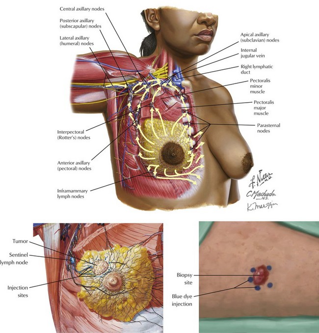 Sentinel Lymph Node Biopsy Basicmedical Key