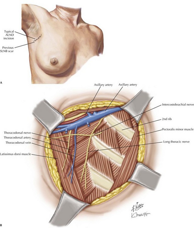 Axillary And Inguinal Lymphadenectomy Basicmedical Key 