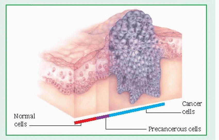 Is A Neoplasm Malignant