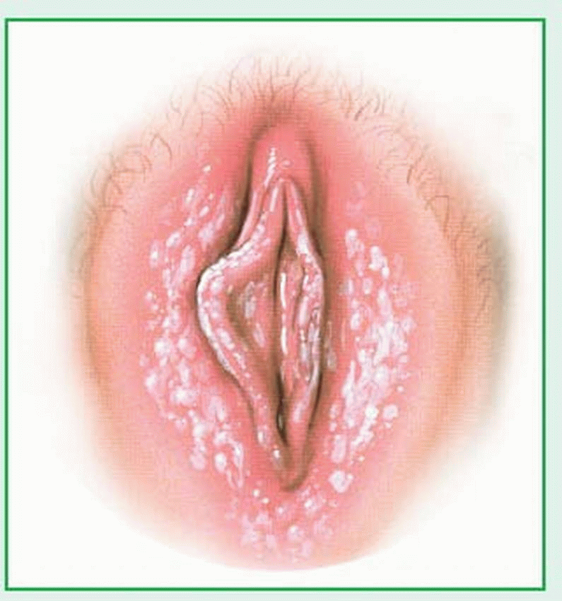 Pink tinted vaginal discharge