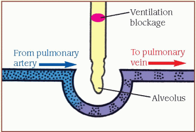 dead space ventilation perfusion ratio