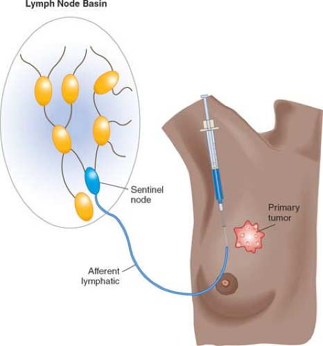 The sentinel lymphatic pathways of a clinical node-positive patient