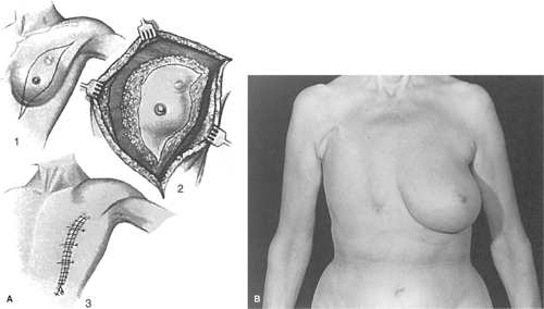 Patient F - Bilateral Breast Reconstruction following Breast Cancer -  Patient's left breast was previously reconstructed following a left breast  mastectomy, radiation, and a latissimus flap. — Dr Giuffre Plastic Surgeon  Edmonton