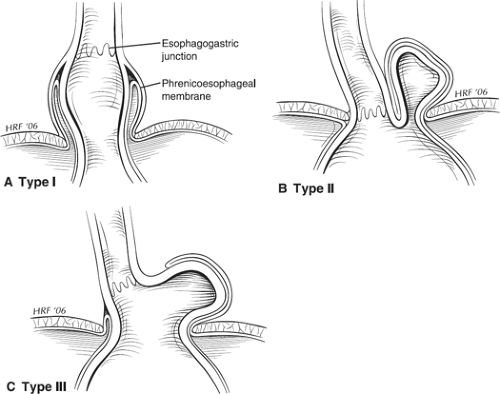 Paraesophageal Hernia Anatomy