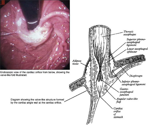 modified-hill-repair-for-gastroesophageal-reflux-basicmedical-key