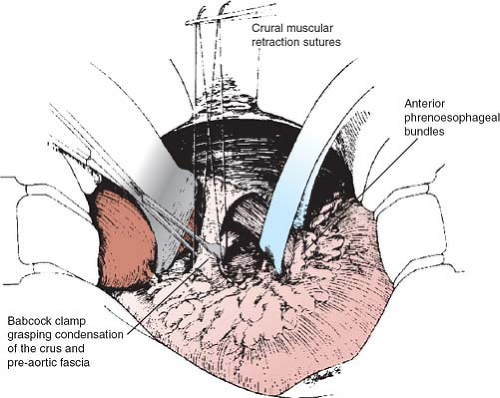 modified-hill-repair-for-gastroesophageal-reflux-basicmedical-key