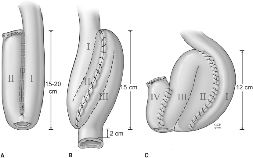 Ileoanal Pouch Procedure For Ulcerative Colitis And Familial Adenomatous Polyposis 9218