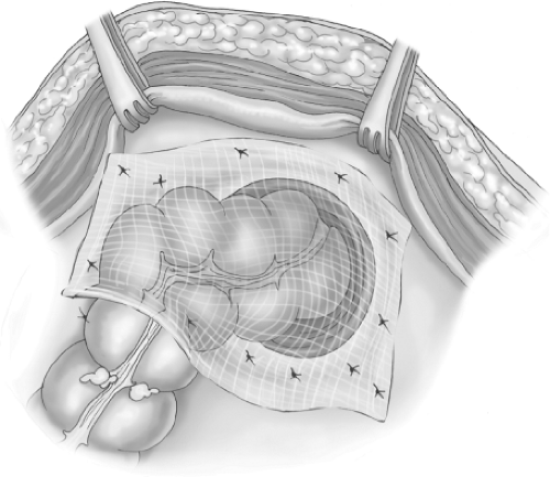 Ventral Abdominal Hernia | Basicmedical Key