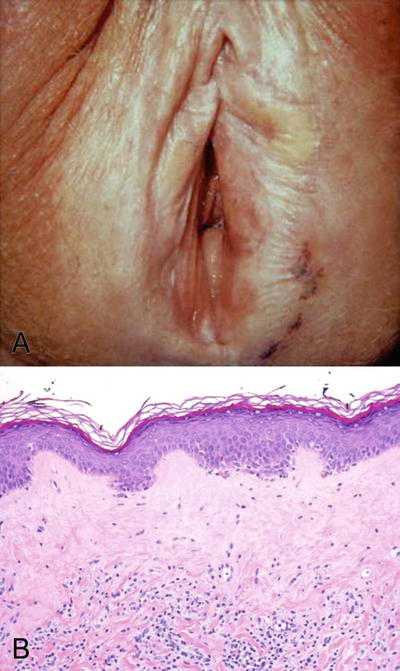 vulvar melanosis