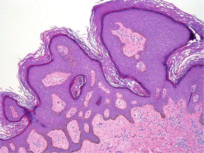 vestibular papillomatosis histopathology)